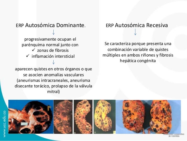 enfermedad poliquistica renal autosomica dominante
